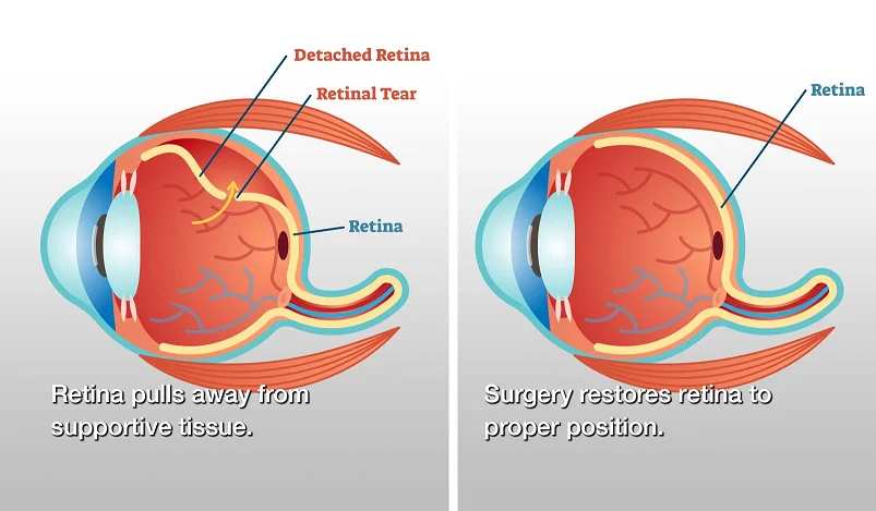 Retinal Detachment Surgery