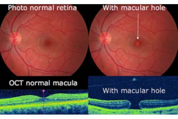 Macular Hole Surgery