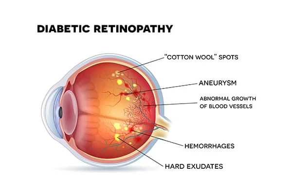 Diabetic Retinopathy