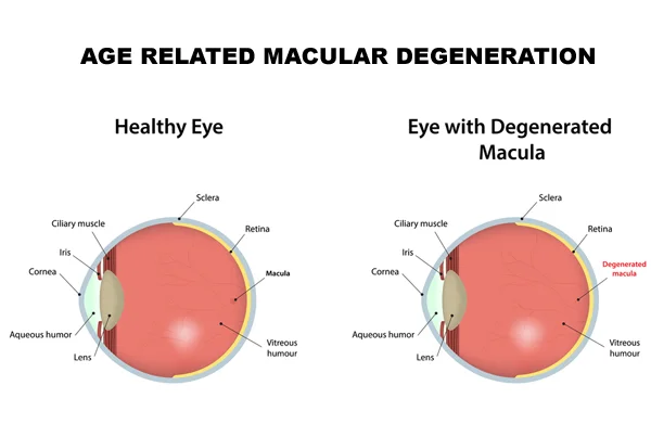 Age Related Macular Degeneration