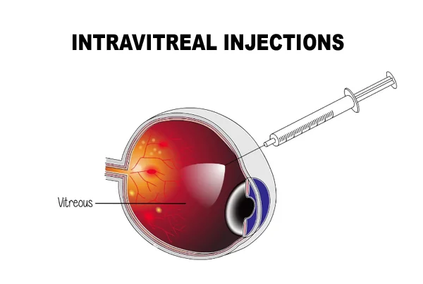 Intravitreal Injections