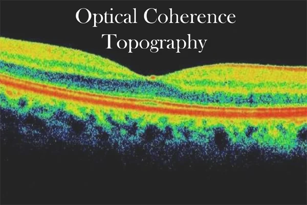 Optical Coherence Tomography