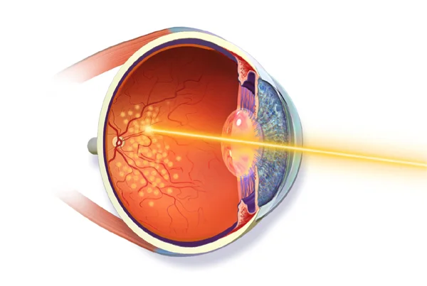 Retinal Lasers