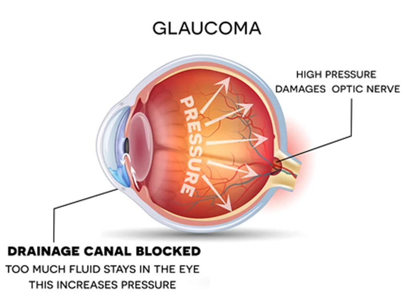 Glaucoma
